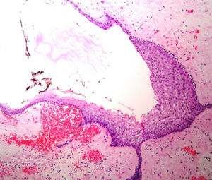 Histopathological image with haematoxylin and eosin stain showing the presence of central nervous tissue at the periphery, and a cyst covered by non-keratinised stratified squamous epithelium.