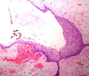 Histopathological image with haematoxylin and eosin stain showing the presence of central nervous tissue at the periphery, and a cyst covered by non-keratinised stratified squamous epithelium.