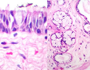 Other types of epithelia were also identified: mucosecretory epithelium on the left and high columnar epithelium with respiratory-type cilia on the right.