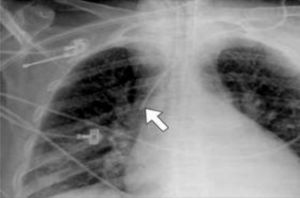 CVC in SVC on X-ray.12