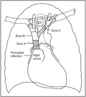 Schematic zones for positioning the CVC tip.13