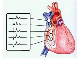 P-wave morphology changes according to the position of the CVC tip.16