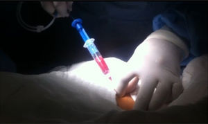 Introducing the metal guide wire using a syringe and needle.