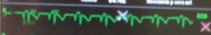 Isobiphasic P-wave.