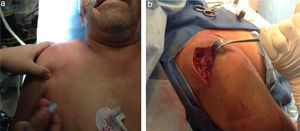 (a) Increase in volume, hyperthermia and hyperaemia from the deltoid area to the middle third of the clavicle. (b) 10cm3 of subdeltoid and 2cc3 of articular purulent material were obtained.