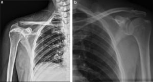 Comparative shoulder X-rays: (a) Right shoulder X-ray: volume increase in soft tissues, with radiolucent images compatible with subcutaneous emphysema; irregular acromioclavicular bone edges, right acromioclavicular joint 9.61mm. (b) Left shoulder X-ray: Acromioclavicular space 1.41mm without any bone injury data.