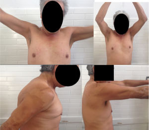 Follow-up after 9 months: Right shoulder range of motion: abduction: 0°–180°; abduction: 0°–90°, without pain; flexion: 0°–170°; extension: 0°–40°.