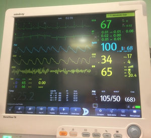 Thoracoscopy monitoring.