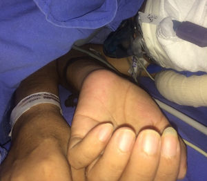 Patient in lateral decubitus position for thoracoscopy. Facial mask for appropriate supply of oxygen and bispectral index transducer.
