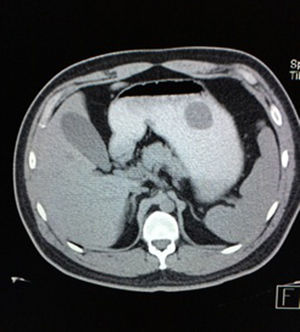Abdominal CT scan (cross-section) shows hypodense dumb-ball shaped image with borders well-defined arising from the greater curvature of stomach.