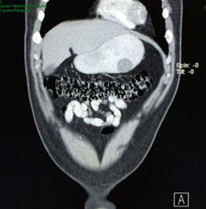 Abdominal CT scan (coronal-section). Hypodense image in stomach.