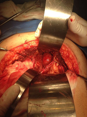 Intragastric tumor attached to the posterior wall and also to the greater curvature.