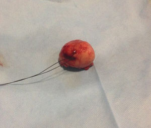 Resected gastric tumor. Size 4.5cm in major axis.