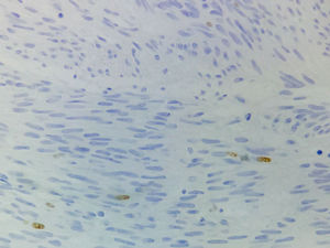 Immunohistochemical image. Tumor neoplastic cells staining positive for KIT (CD117) and Ki-67 at 2%.