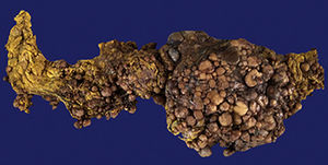 Omental tumour (external surface). Size: 50cm×30cm×15cm. 3.5kg.