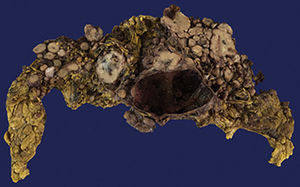Omental tumour (cut surface).