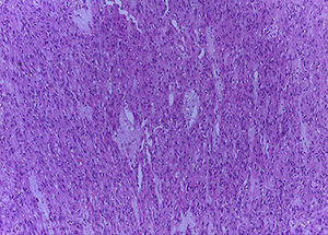 Optical microscopy of solid spindle cell neoplasm (10×).