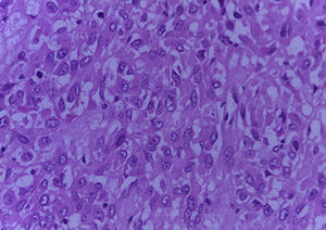 Optical microscopy of solid epithelial neoplasm (40×).