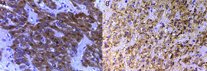 (A) Positive CD117 marker (cytoplasm). (B) Positive DOG1 marker (membrane and cytoplasm).