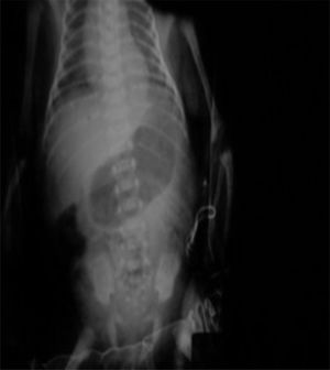 X-ray of abdomen and chest. Note the presence of gastromegaly.