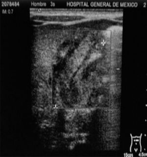 Pyloric ultrasound. Note increased length and thickness of muscle wall.