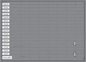 Asymmetry in the left temporal region with presence of low voltage spikes in the contacts F7, T3, T5 with phase opposition in T3.