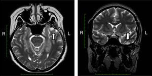 Small irregular and hyperintense nodular image in the T2 sequence located in the rostral part of the left inferior temporal gyrus, with a greater central signal and with deep hypointensity in the contour, less than 1cm, whose characteristics correspond to a cavernous angioma.