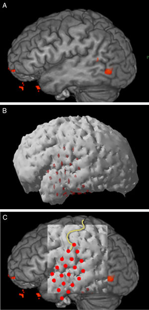 3D reconstruction and correlation in area 4, patient 3. A: Presurgical fMRI. B: Postsurgical structural MR reconstruction. C: Correlation of both studies, the central sulcus and grid electrodes have been highlighted.