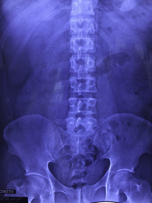 Patient X-ray prior to his surgical event, supine.