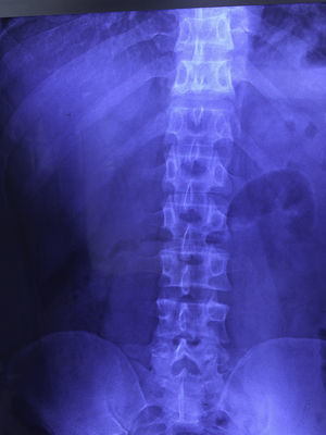 Patient X-ray prior to his surgical event, standing.