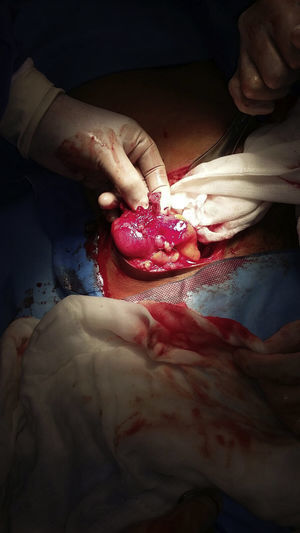 Epipploic appendix twisted and gangrenous.