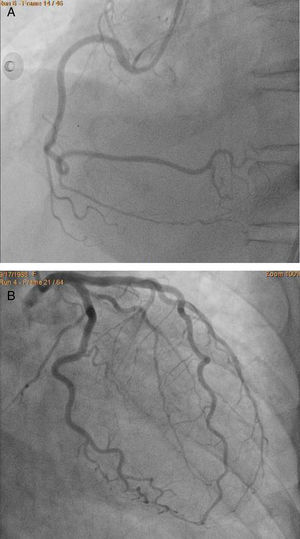 (A) Right coronary artery in RAO view without evidence of obstructive lessions, (B) left coronary artery in RAO view without evidence of obstructive lession in any segment.