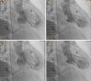 Ventriculography in RAO view showing motion abnormalities of the left ventricle. (A) end-diastole, (B) end-systole, (C) the same image seen in A but with enhanced endocardial border which shows normal cavity contours, and (D) the same image seen in B but with enhanced endocardial borders showing a pattern of apical ballooning, impaired mid-ventricular contractility and normal motion of the basal segments.