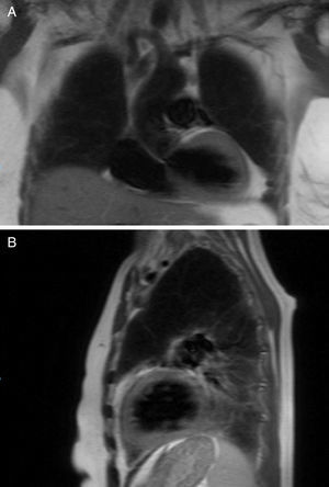 T2 weighted cardiac magnetic resonance in which an homogenic myocardium is observed with no evidence of edema as marker of an inflamatory process; (A) coronal view (B) sagital view.