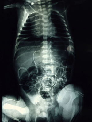 AP X-ray of chest/abdomen. Free gas in abdominal cavity.