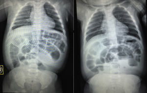 Simple X-ray of abdomen standing and decubitus showing poor distribution of air, distension of the small intestine and colon, absence of air in pelvic gap, fluid and gas levels.