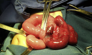 Terminal ileum with reduced perfusion, Meckel's diverticulum 40cm from the ileocaecal valve.