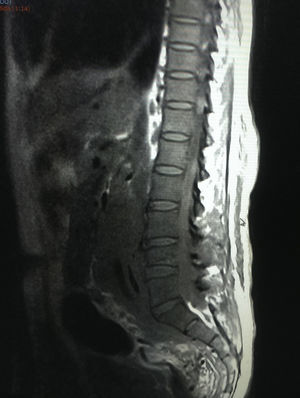 Sagittal MRI cut showing how the tumour affects the retroperitoneum and major vessels.