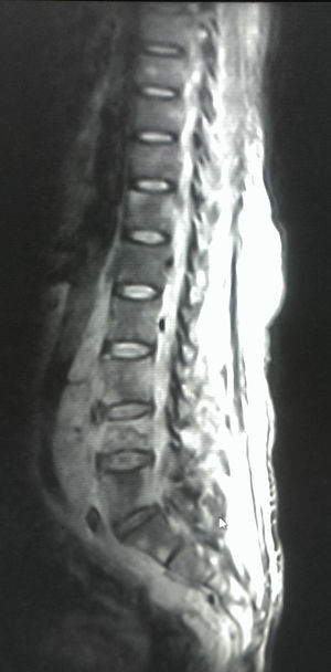 Sagittal MRI cut showing spinal invasion.