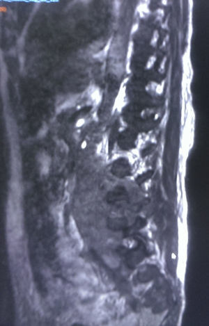 Sagittal MRI cut showing invasion and destruction of vertebrae.