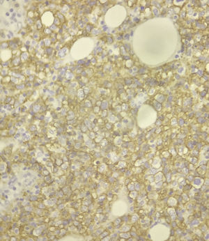 Microphotograph with immunohistochemistry showing CD20 positivity.