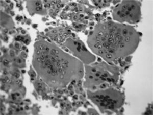 Microscopic image of GCT. It shows mononuclear cells and numerous giant cells distributed in a non-uniform manner.