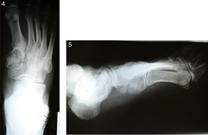 Post-surgical foot X-rays. They show tumour cavity with bone graft.