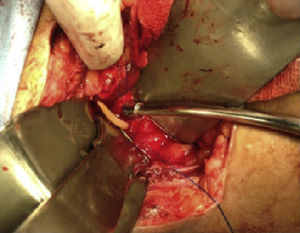 Exploration of the bile duct with roundworm coming out of the choledochotomy site.