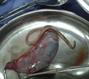 Surgical specimen from cholecystectomy plus Ascaris lumbricoides extracted from the bile duct.