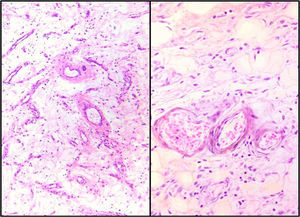 Microscopic appearance (Case 1. Image on left, Case 2. Image on right).