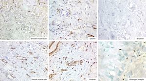 Immunohistochemical panel. Photomicrographs of representative reactants (Case 1. Images above, Case 2. Images below).