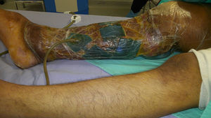 Limb after graft and placement of ABThera-VAC system.