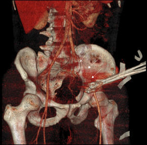 Artery reconstruction computer tomography angiography (CTA). (Straightforward identification of the iliac artery lesion.)