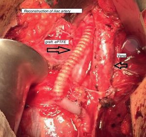 Anastomosis of PTFE graft from the external iliac artery to the femoral artery.